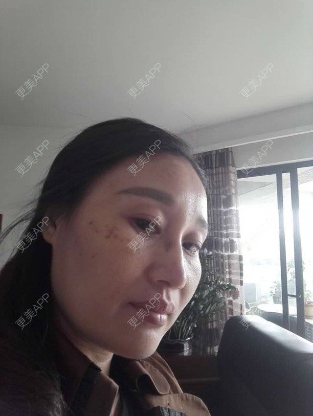 更美 - 更美用户M0GeHCOhRS的激光淡斑经验 | 激光淡斑 | 激光雀斑 | 皮肤美容 | 广州