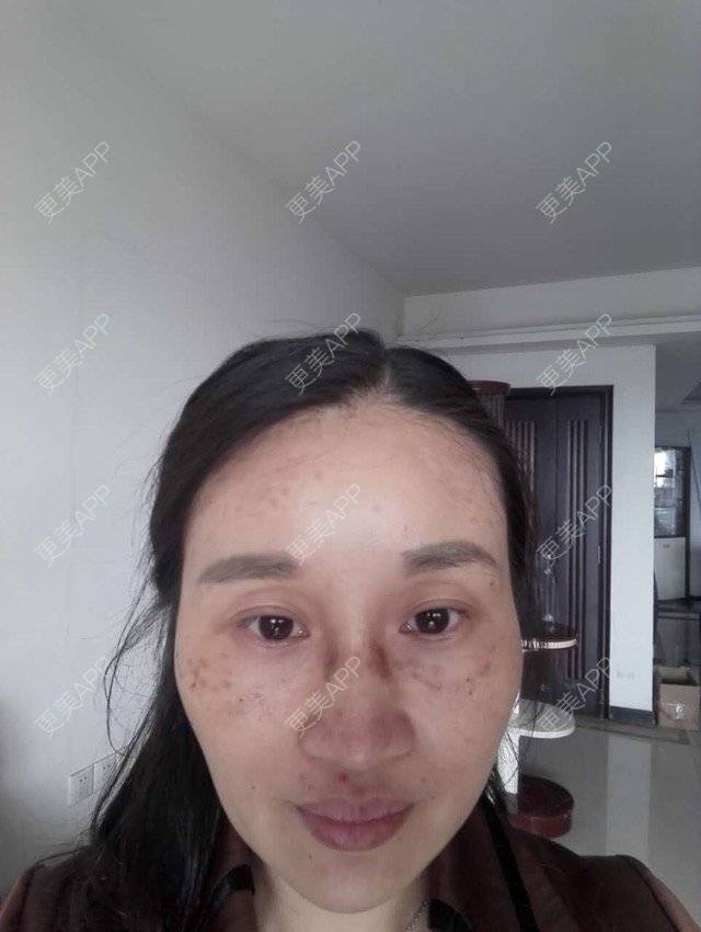 更美 - 更美用户M0GeHCOhRS的激光淡斑经验 | 激光淡斑 | 激光雀斑 | 皮肤美容 | 广州