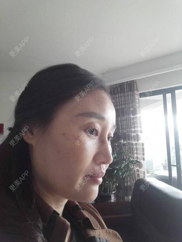 更美 - 更美用户M0GeHCOhRS的激光淡斑经验 | 激光淡斑 | 激光雀斑 | 皮肤美容 | 广州