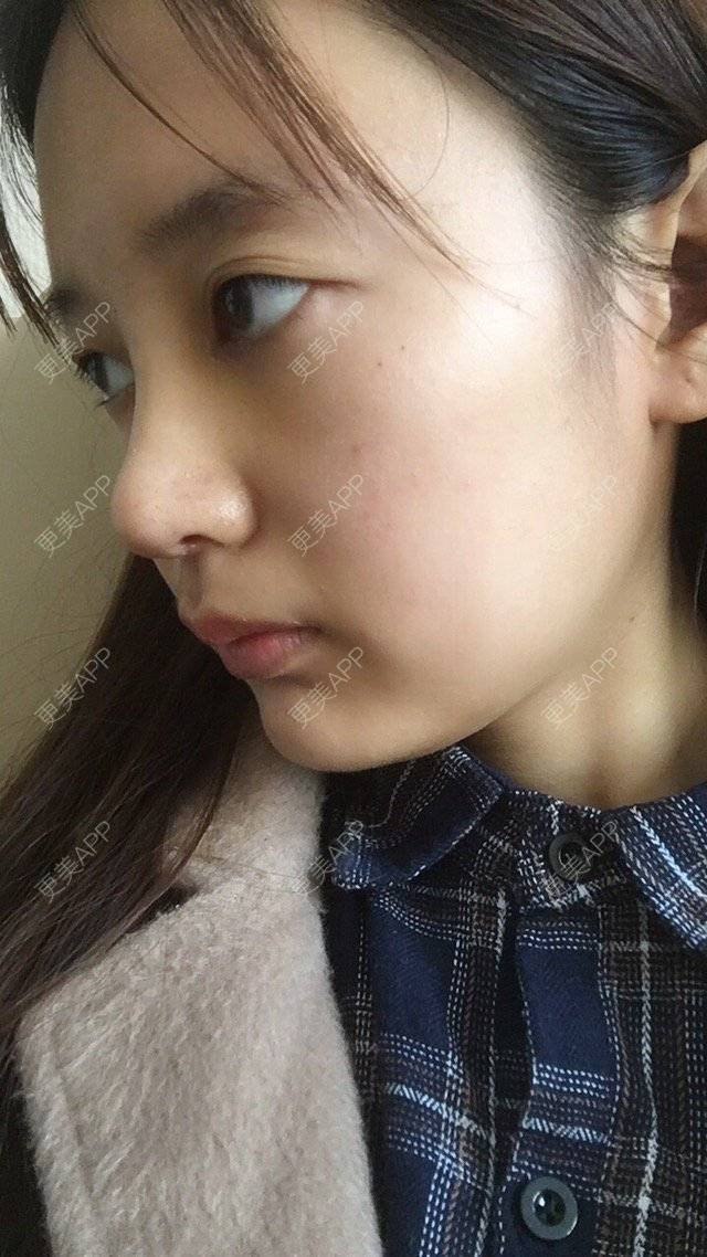 更美 - 匆匆1108的全脸整形套餐经验 | 全脸整形套餐 | 武汉 | 鼻部整形 | 隆鼻 | 鼻部多项