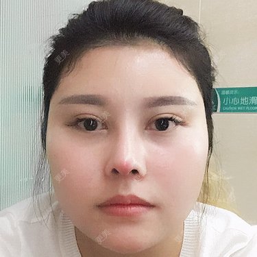 V脸套餐