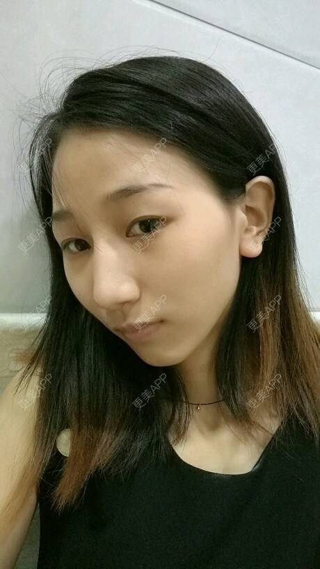 更美 - 凤凰传奇123的驼峰鼻矫正经验 | 成都 | 驼峰鼻矫正