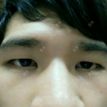 眼皮下垂矫正