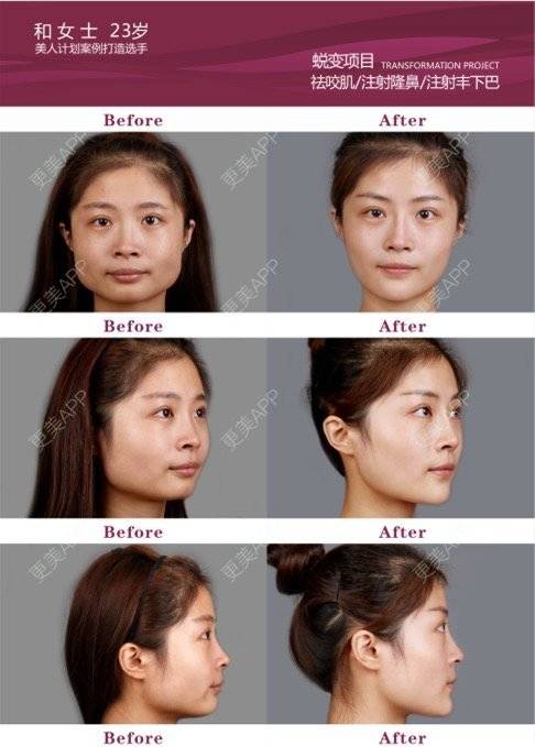 更美 - 西安高一生医疗美容医院的玻尿酸唇部经验 | 玻尿酸唇部 | 西安