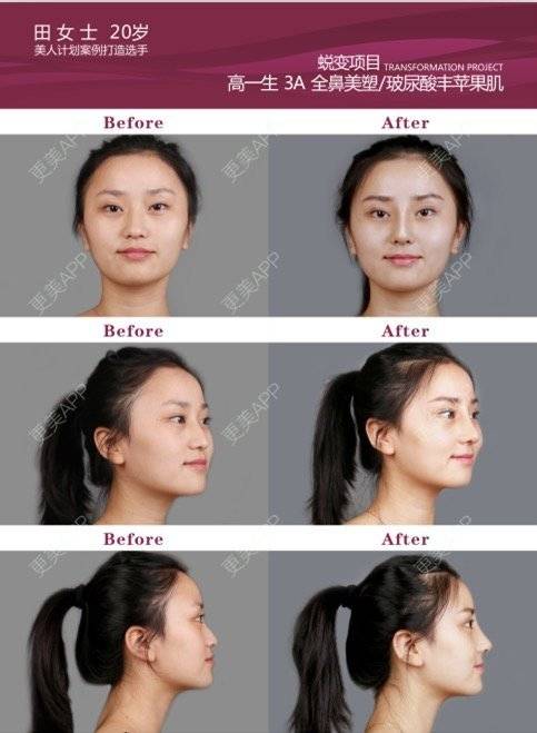 更美 - 西安高一生医疗美容医院的玻尿酸唇部经验 | 玻尿酸唇部 | 西安
