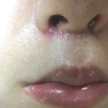 发炎