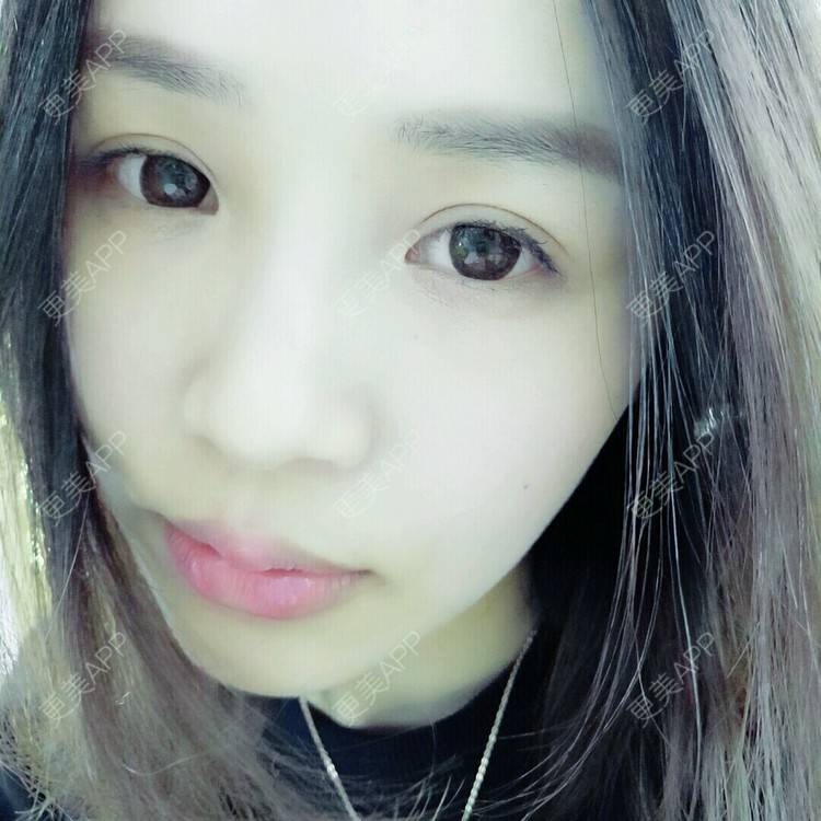 更美 - 更美用户NV7JIp6Bfc的玻尿酸唇部经验 | 玻尿酸唇部 | 武汉