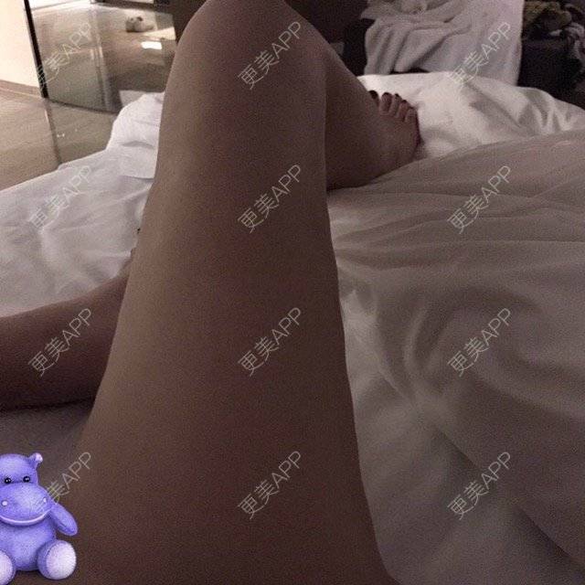 更美 - 朱渺 医生的吸脂瘦大腿经验 | 长沙 | 吸脂瘦大腿