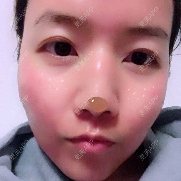 更美 - Lynn🦋💫💫💫的经验 | 祛痘坑 | 点阵激光 | 郑州 | 淡化痘印