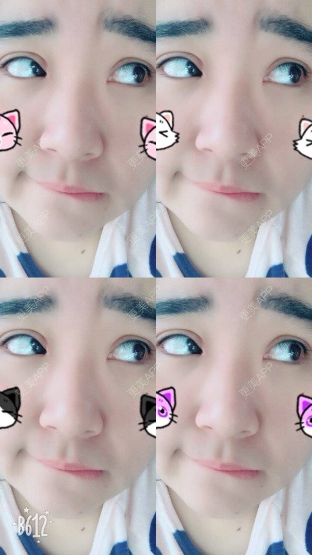 更美 - 超甜超甜的双眼皮经验 | 北京 | 视频日记 | 双眼皮