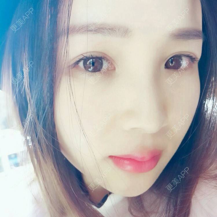 更美 - 更美用户NV7JIp6Bfc的玻尿酸唇部经验 | 玻尿酸唇部 | 武汉