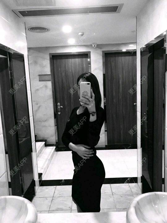 更美 - 网络主播欧美妹子的自体脂肪全面部填充经验 | 自体脂肪丰太阳穴 | 广州 | 自体脂肪全面部填充 | 自体脂肪丰额头