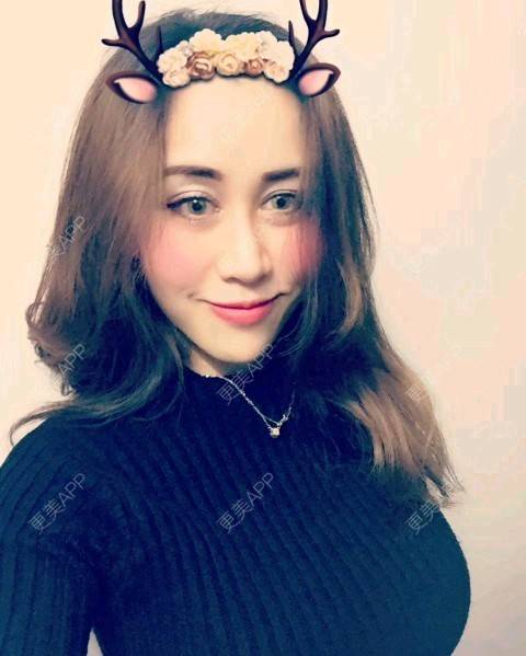 更美 - 网络主播欧美妹子的自体脂肪全面部填充经验 | 自体脂肪丰太阳穴 | 广州 | 自体脂肪全面部填充 | 自体脂肪丰额头