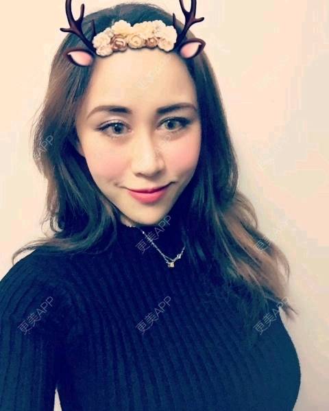 更美 - 网络主播欧美妹子的自体脂肪全面部填充经验 | 自体脂肪丰太阳穴 | 广州 | 自体脂肪全面部填充 | 自体脂肪丰额头