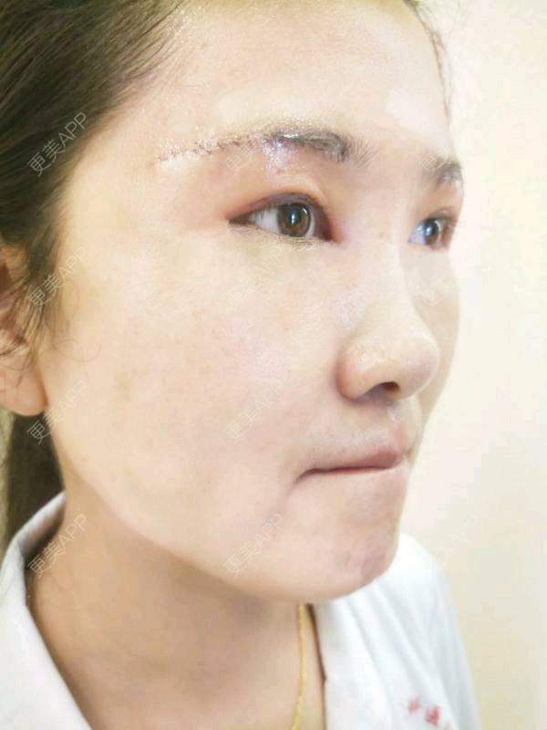 更美用户fjf9esks2e的切眉日记