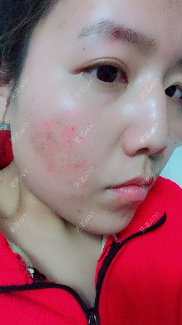 更美 - Lynn🦋💫💫💫的经验 | 祛痤疮斑痕痘坑 | 郑州