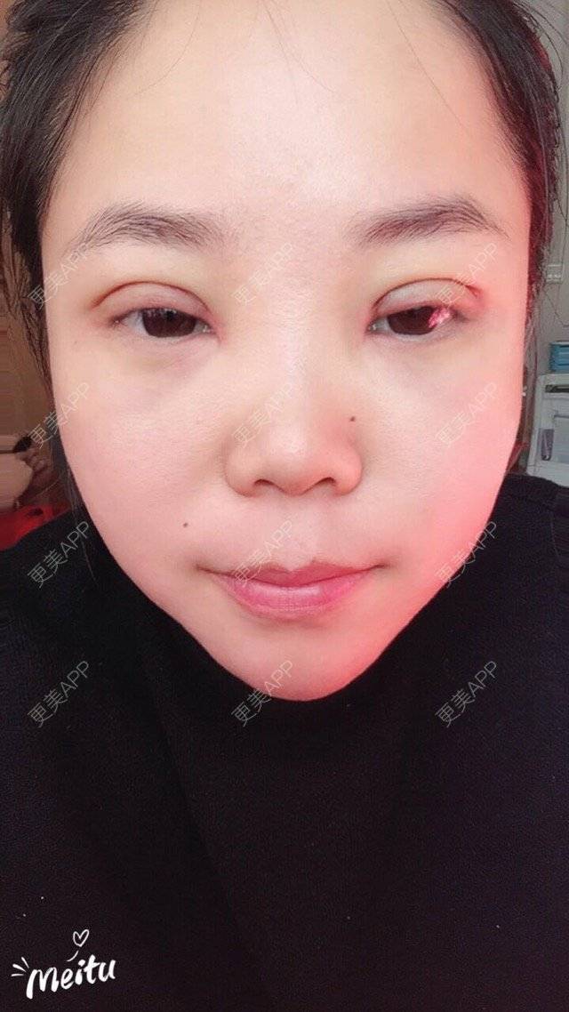 更美 - 飞翔晓琳的祛眼袋经验 | 北京 | 不开刀去眼袋 | 祛眼袋 | 激光去眼袋