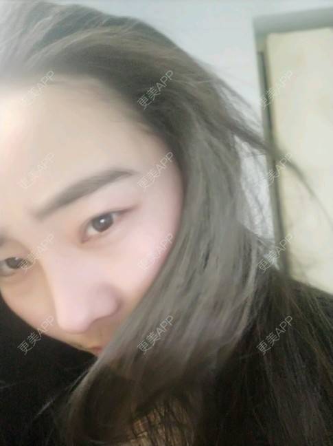 更美 - EB54B7B5的鼻中隔软骨垫鼻头经验 | 膨体隆鼻 | 郑州 | 视频日记 | 鼻中隔软骨垫鼻头