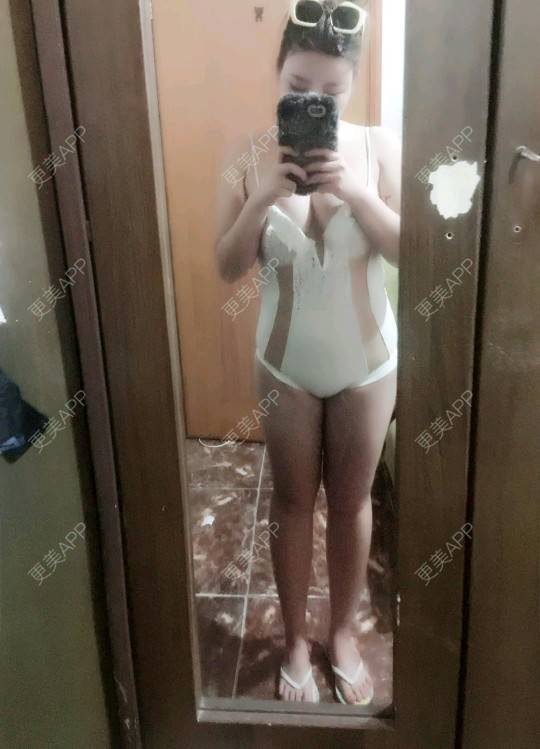 更美 - 更美用户uhjgJzL3xQ的吸脂瘦大腿经验 | 广州 | 瘦身美体 | 吸脂 | 吸脂瘦大腿