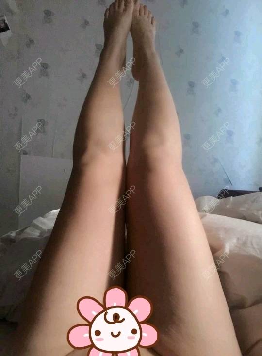 更美 - 更美用户uhjgJzL3xQ的吸脂瘦大腿经验 | 广州 | 瘦身美体 | 吸脂 | 吸脂瘦大腿
