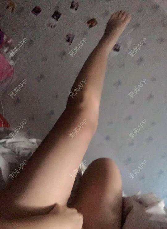 更美 - 更美用户uhjgJzL3xQ的吸脂瘦大腿经验 | 广州 | 瘦身美体 | 吸脂 | 吸脂瘦大腿