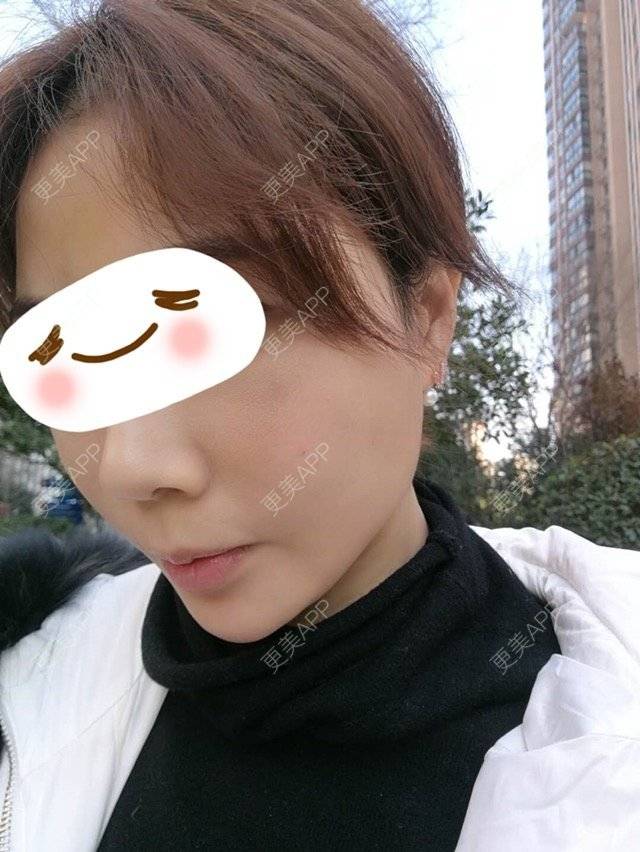 更美 - 更美用户8f5rKzwaNL的埋线除皱经验 | 埋线除皱 | 武汉