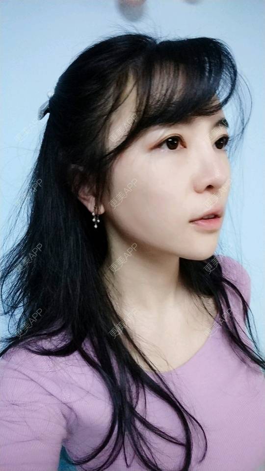 更美 - 向阳葵21的埋线提升经验 | 埋线提升 | 重庆