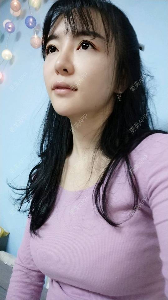 更美 - 向阳葵21的埋线提升经验 | 埋线提升 | 重庆