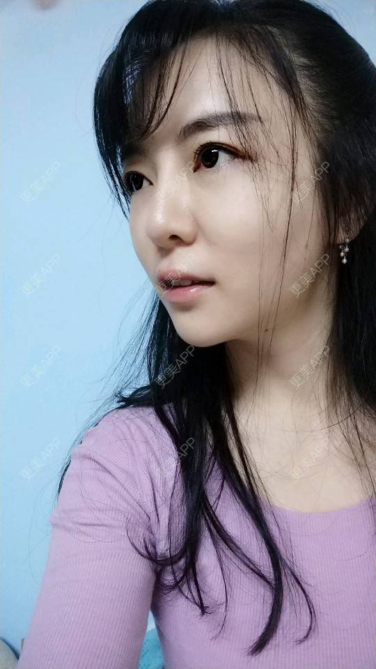 更美 - 向阳葵21的埋线提升经验 | 埋线提升 | 重庆