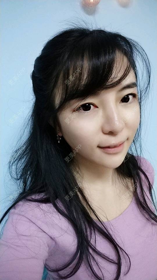 更美 - 向阳葵21的埋线提升经验 | 埋线提升 | 重庆