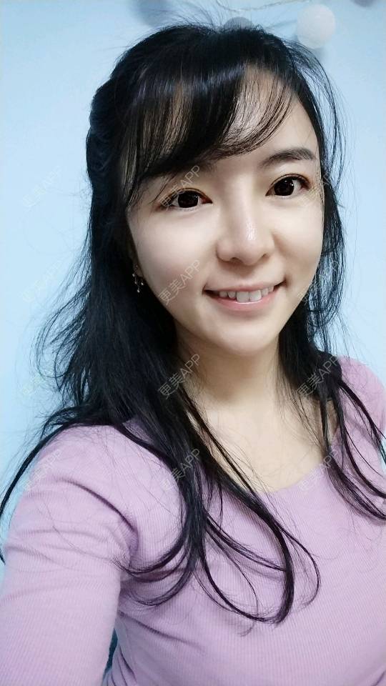 更美 - 向阳葵21的埋线提升经验 | 埋线提升 | 重庆