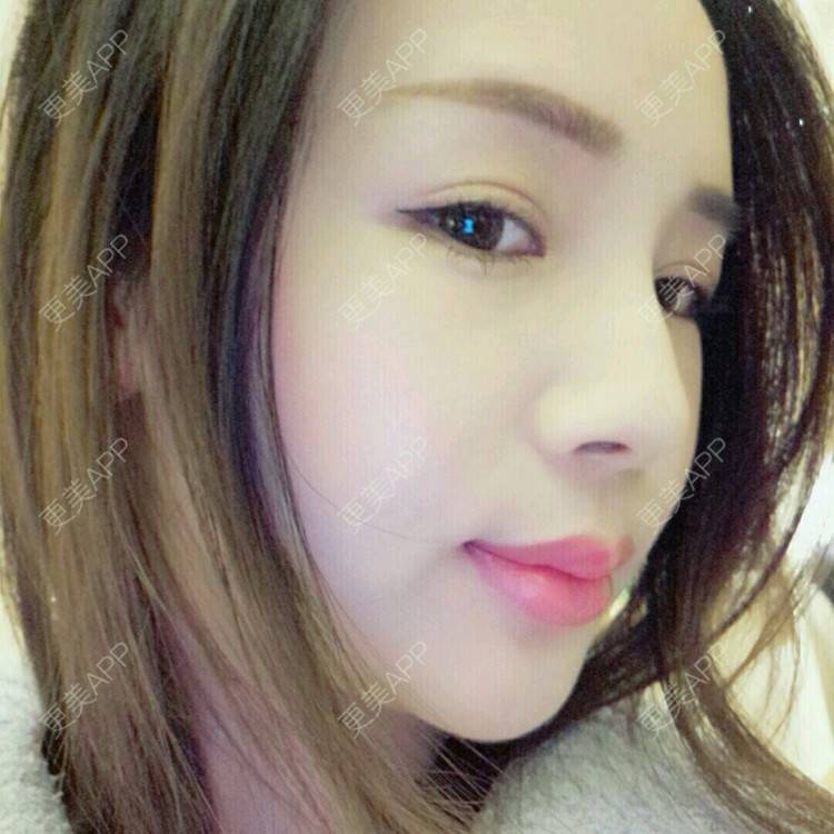 更美 - 更美用户NV7JIp6Bfc的玻尿酸唇部经验 | 玻尿酸唇部 | 武汉