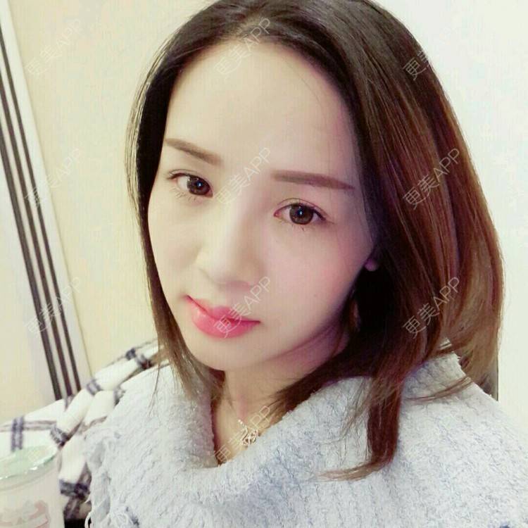 更美 - 更美用户NV7JIp6Bfc的玻尿酸唇部经验 | 玻尿酸唇部 | 武汉