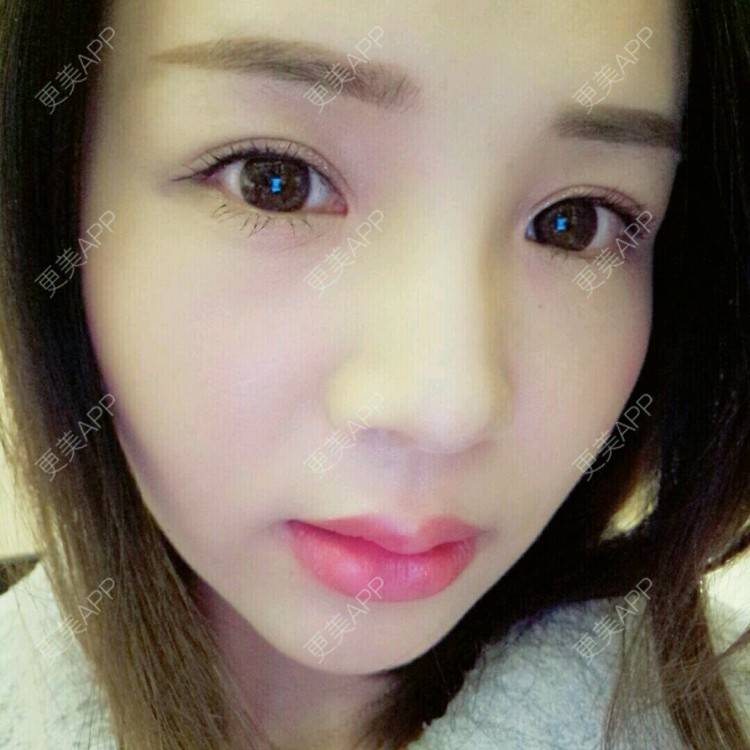 更美 - 更美用户NV7JIp6Bfc的玻尿酸唇部经验 | 玻尿酸唇部 | 武汉