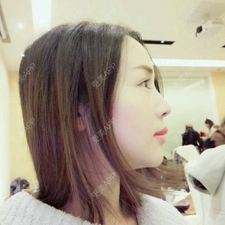 更美 - 更美用户NV7JIp6Bfc的玻尿酸唇部经验 | 玻尿酸唇部 | 武汉