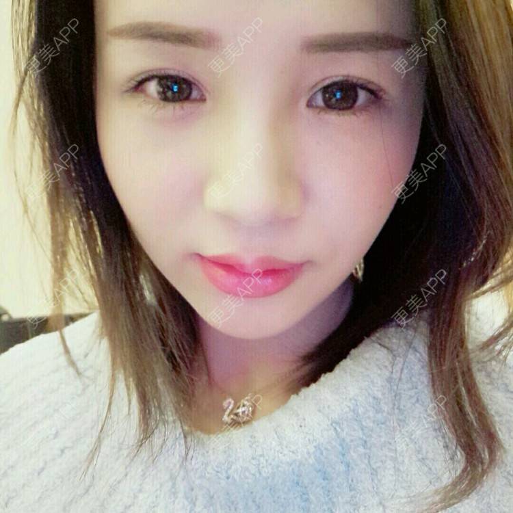 更美 - 更美用户NV7JIp6Bfc的玻尿酸唇部经验 | 玻尿酸唇部 | 武汉