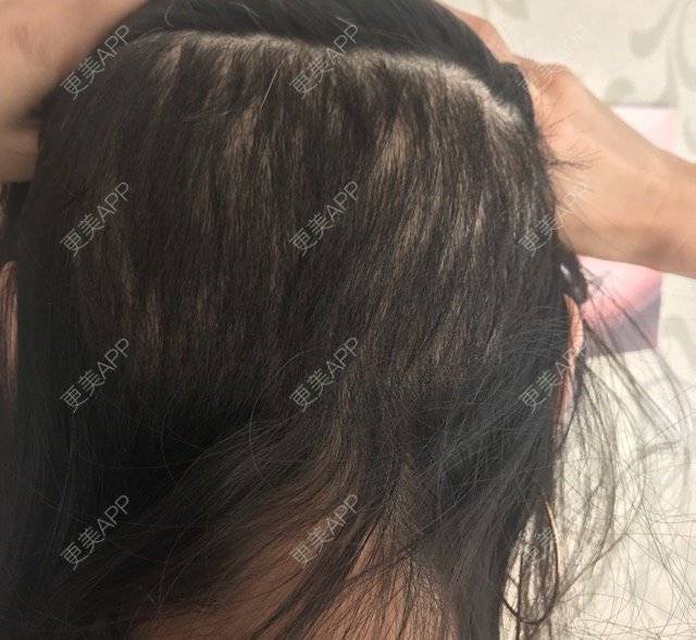 更美 - ꧁Du美高端美妆商学院꧂的毛发移植经验 | 发际线移植 | 沈阳 | 毛发移植
