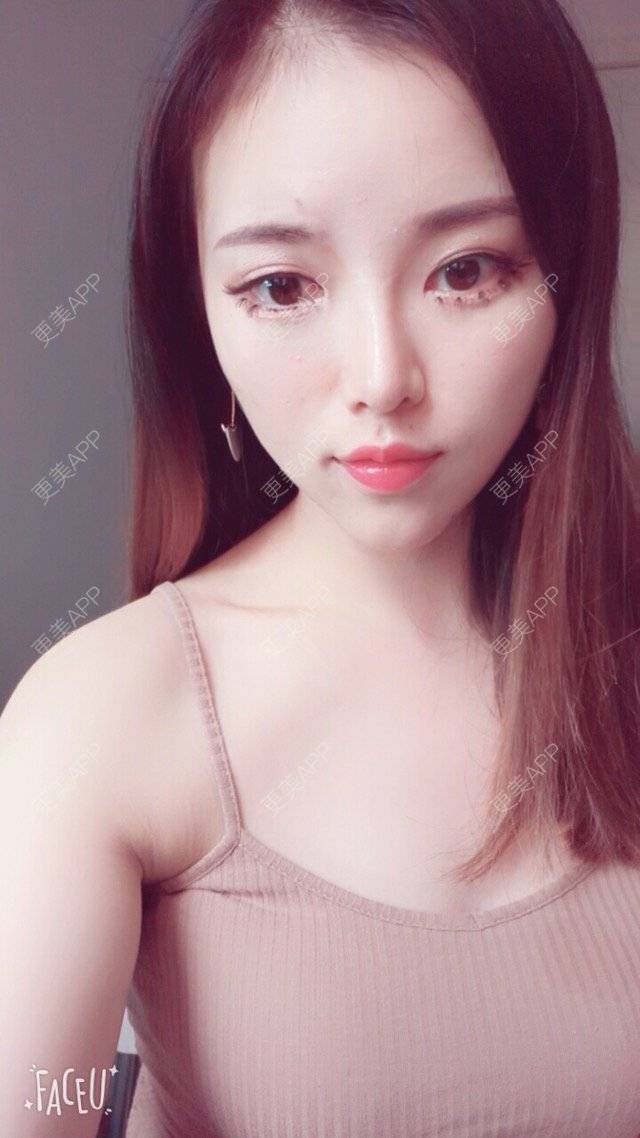 更美 - 错位的梦兮的硅胶垫下巴经验 | 硅胶垫下巴 | 武汉