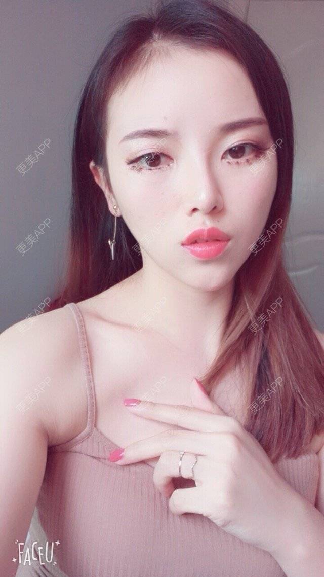 更美 - 错位的梦兮的硅胶垫下巴经验 | 硅胶垫下巴 | 武汉