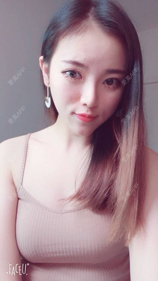 更美 - 错位的梦兮的硅胶垫下巴经验 | 硅胶垫下巴 | 武汉