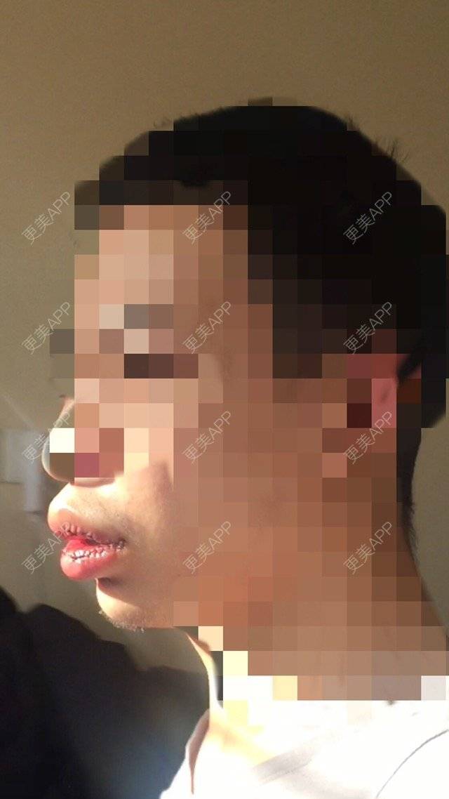 更美 - 裂口男一号的M唇成形经验 | M唇成形 | 北京