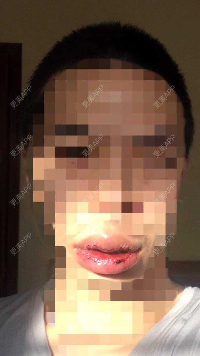 更美 - 裂口男一号的M唇成形经验 | M唇成形 | 北京