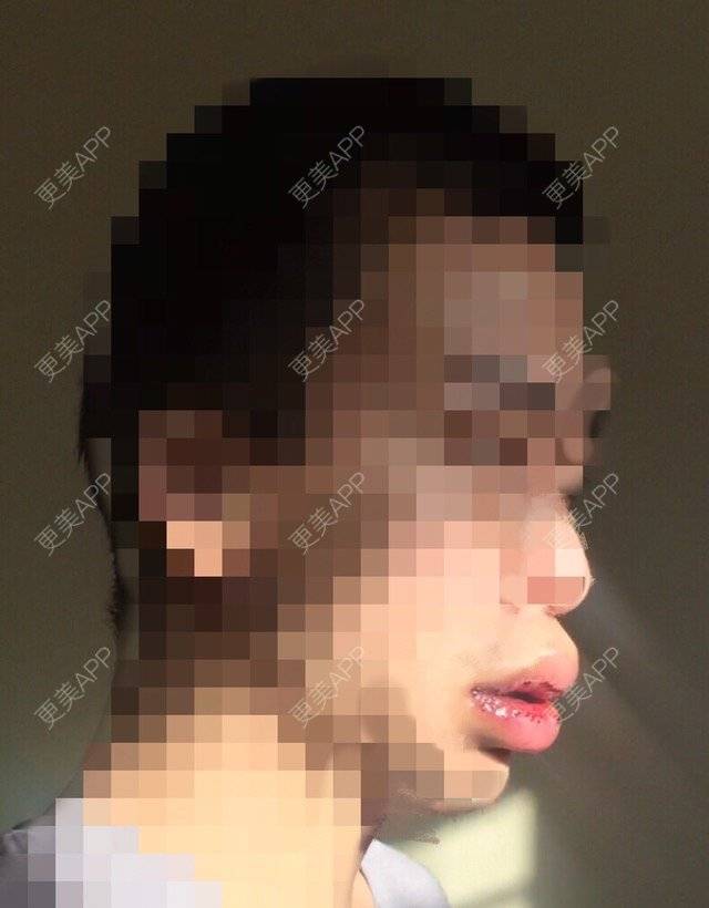 更美 - 裂口男一号的M唇成形经验 | M唇成形 | 北京