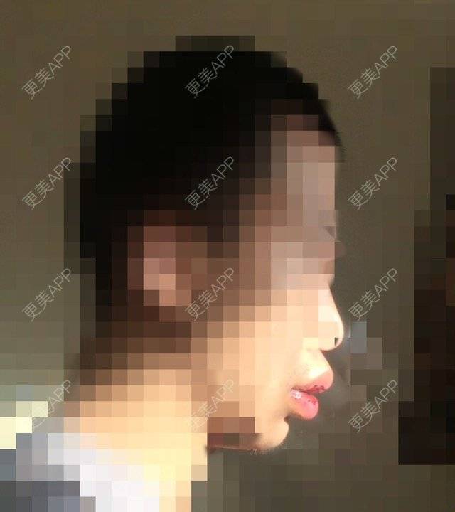 更美 - 裂口男一号的M唇成形经验 | M唇成形 | 北京