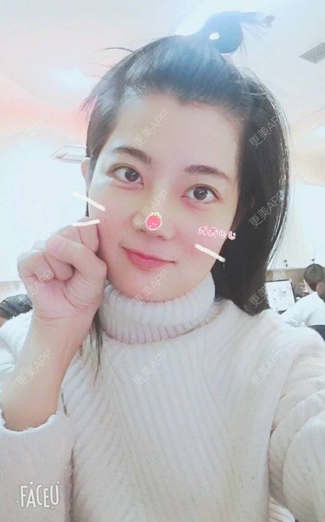 更美 - 西安高一生医疗美容医院的肋软骨隆鼻经验 | 肋软骨隆鼻 | 西安
