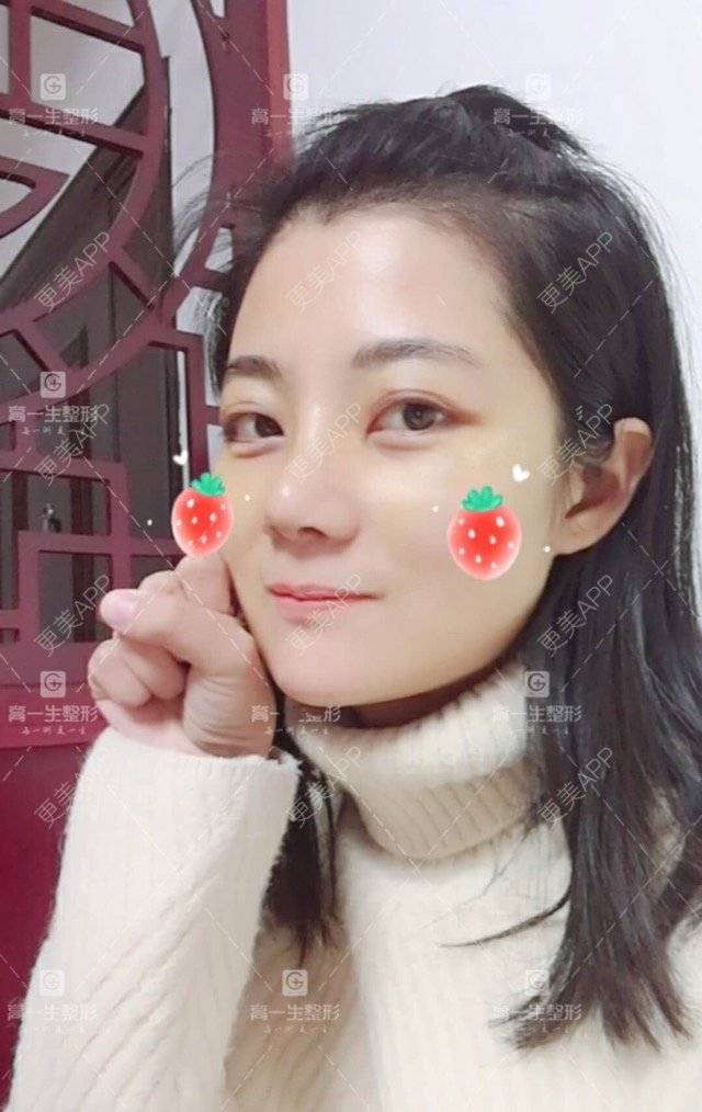 更美 - 西安高一生医疗美容医院的肋软骨隆鼻经验 | 肋软骨隆鼻 | 西安