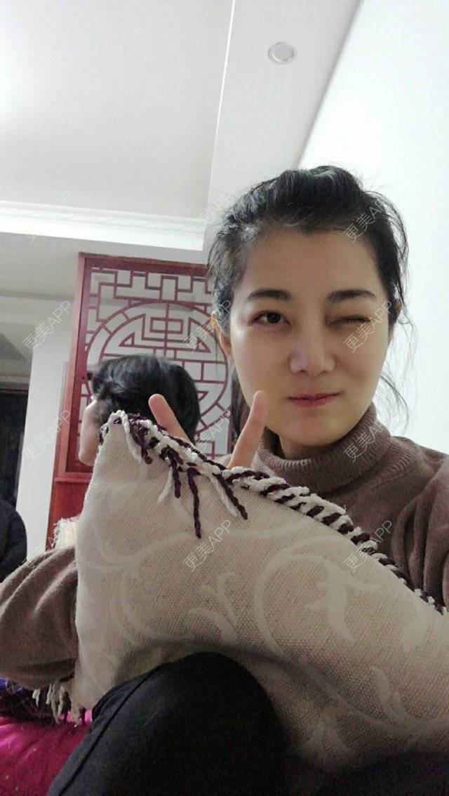 更美 - 西安高一生医疗美容医院的肋软骨隆鼻经验 | 肋软骨隆鼻 | 西安