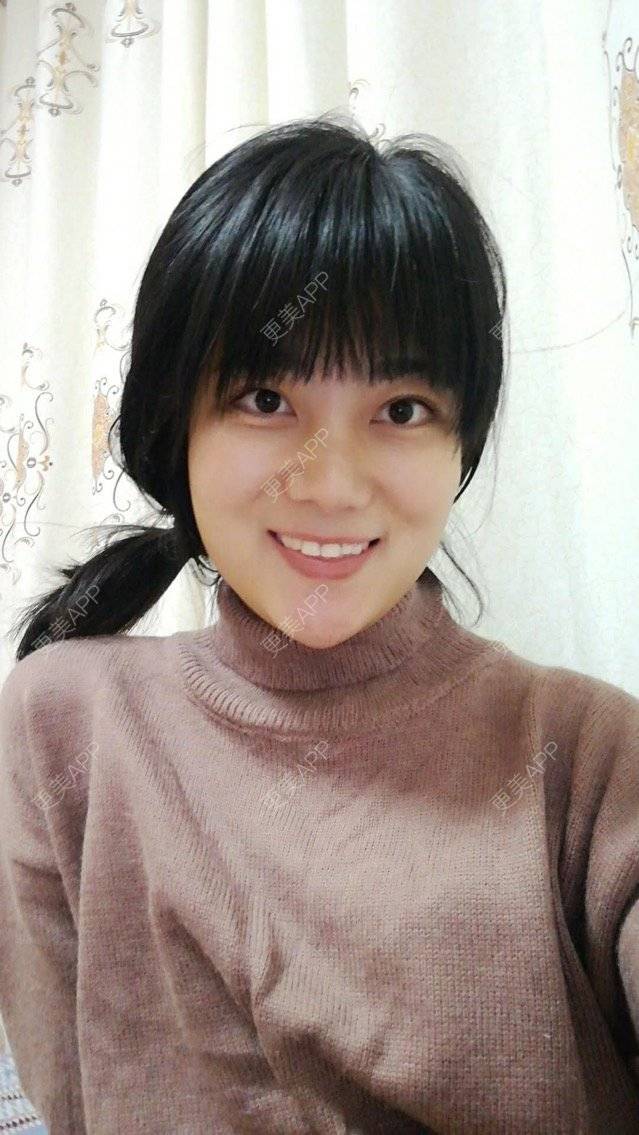 更美 - 西安高一生医疗美容医院的肋软骨隆鼻经验 | 肋软骨隆鼻 | 西安