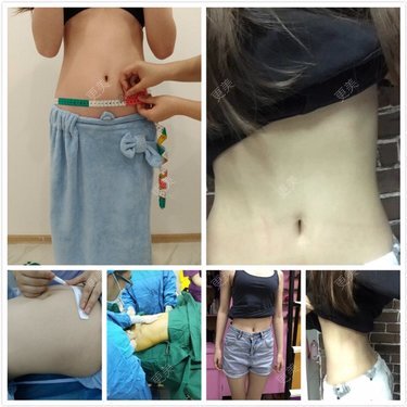 腰腹吸脂
