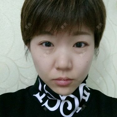 玻尿酸卧蚕